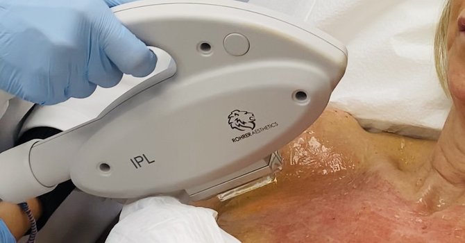 IPL Photofacial 