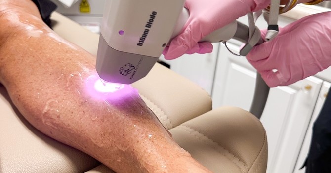 Laser Hair Removal